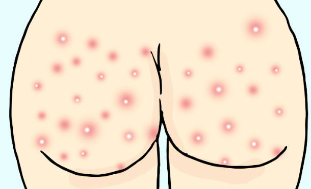 acne cuerpo 1
