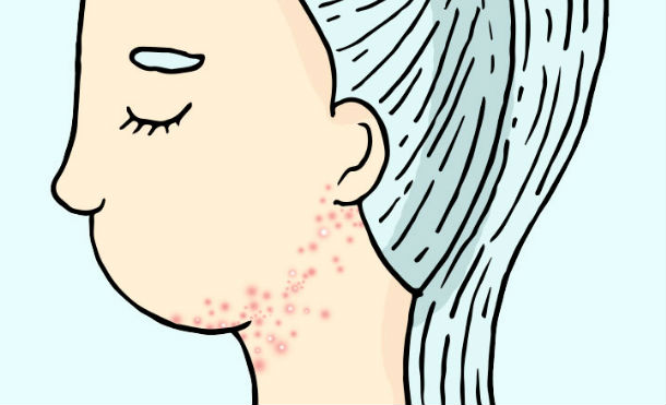 acne cuerpo 2