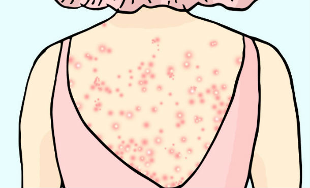 acne cuerpo 3