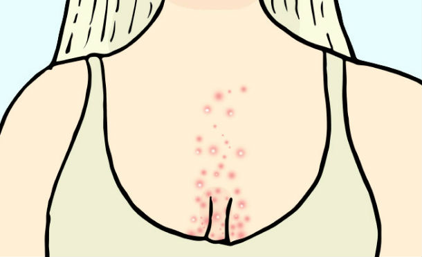 acne cuerpo 4