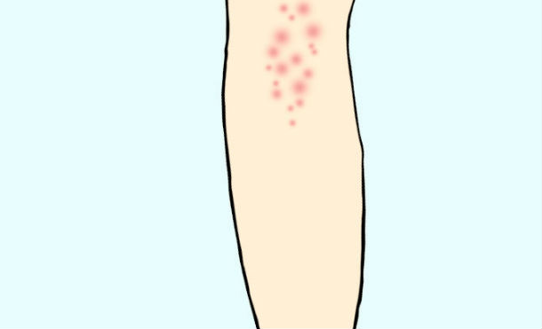 acne cuerpo 5