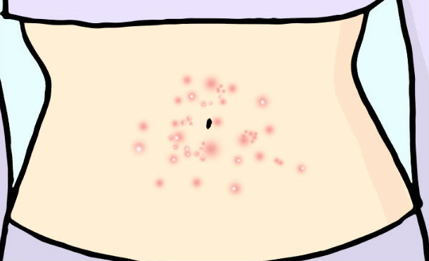 acne cuerpo 6
