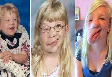 Sufrió bullying por un tumor gigantesco en su rostro, tras una operación luce así y es impactante