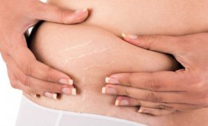 ¡Mujeres! aquí algunos tratamientos para quitar las estrías después del embarazo