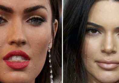 Celebridades como Kendall Jenner también sufren de acné. Pero, aquí la forma para combatirlo