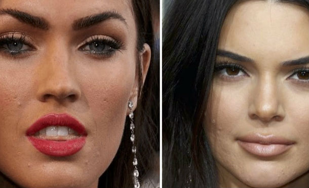 Celebridades como Kendall Jenner también sufren de acné. Pero, aquí la forma para combatirlo