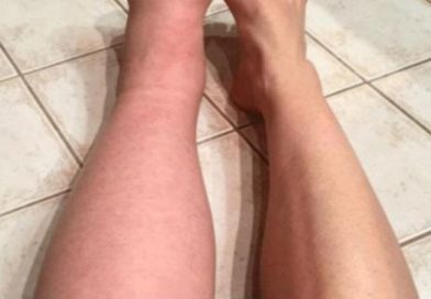 Quedó embarazada y luego notó que una de sus piernas le empezaba a crecer