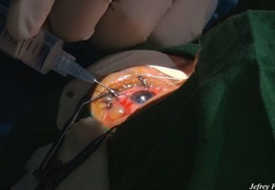 Más nicaragüenses recuperan la vista en jornada quirúrgica en el Centro Nacional de Oftalmología
