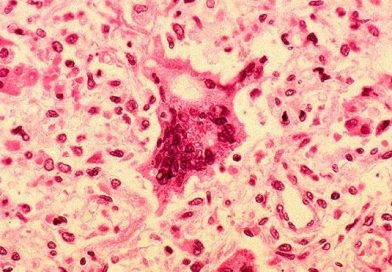 Nicaragua toma medidas preventivas ante casos de sarampión reportados en Costa Rica