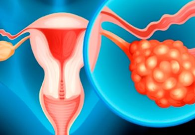 Cuatro puntos claves para combatir el cáncer de ovarios. Foto: tuasaude