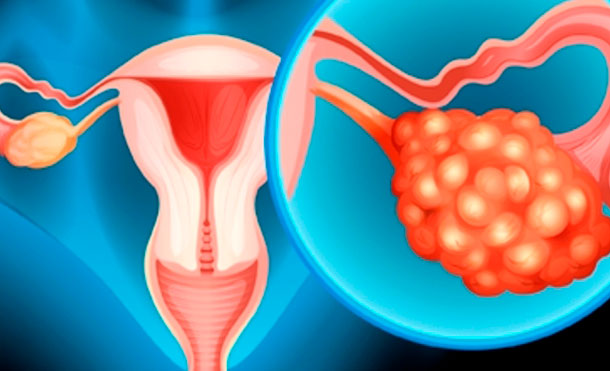 Cuatro puntos claves para combatir el cáncer de ovarios. Foto: tuasaude