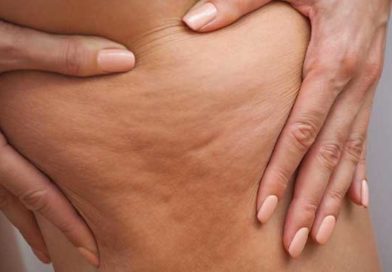 Foto Sanitas: No existe una causa exacta por la que aparece la celulitis, pero existen ciertos factores que la provocan