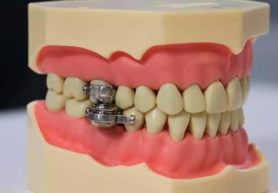 DentalSlim Diet Control