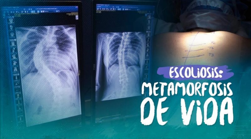 Nicaragua se convierte en el primer país en realizar cirugías de escoliosis gratis