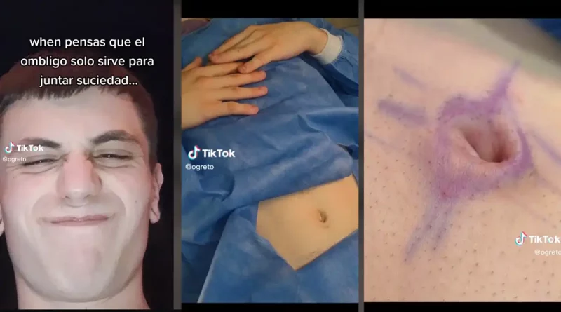 ombligo, argentino, hombre, joven, cirugía, plástica, quiita, quitarse, acumular, suciedad, tiktok, redes,