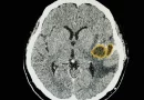 alerta, estados unidos, enfermedad, cerebro, craneo, niños