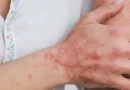 lepra, estados unidos, florida, enfermedad, endemica, alerta, enfermedad de la piel