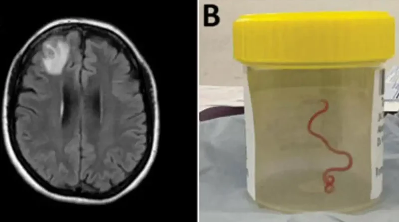 gusano, parásito, extraen vivo, con vida, cerebro, mujer, primer caso, mundo, humanos, registrado, Australia, Ophidascaris robertsi, pitón, serpiente, cirugía, operación, especialistas,