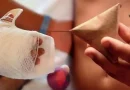 minsa, lesionados por polvora, fuegos artificiales, nicaragua, quemaduras,