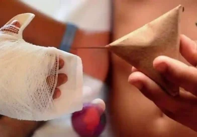 minsa, lesionados por polvora, fuegos artificiales, nicaragua, quemaduras,