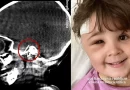 Barcelona, España, niña, extraen, aguja del cerebro, médicos, aguja entró por la mejilla, visita al dentista, caso excepcional,