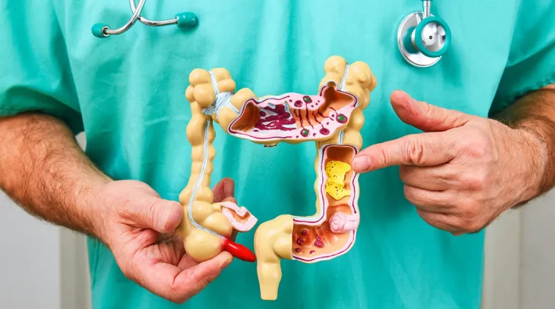 cáncer, cáncer de colon, culpable, posible, investigación, colorrectar, jóvenes, bacteria, colibactina, salud, estudios,