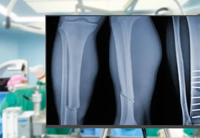 pegamento, China, expertos en ortopedia, desarrollan, pegamento para huesos, fijar fracturas,