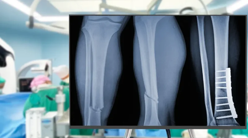 pegamento, China, expertos en ortopedia, desarrollan, pegamento para huesos, fijar fracturas,